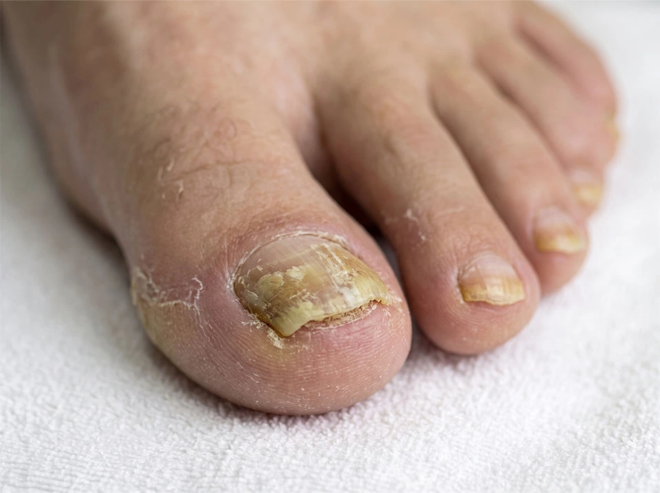 Tratamiento definitivo para hongos en las uñas de los pies en Mexicali