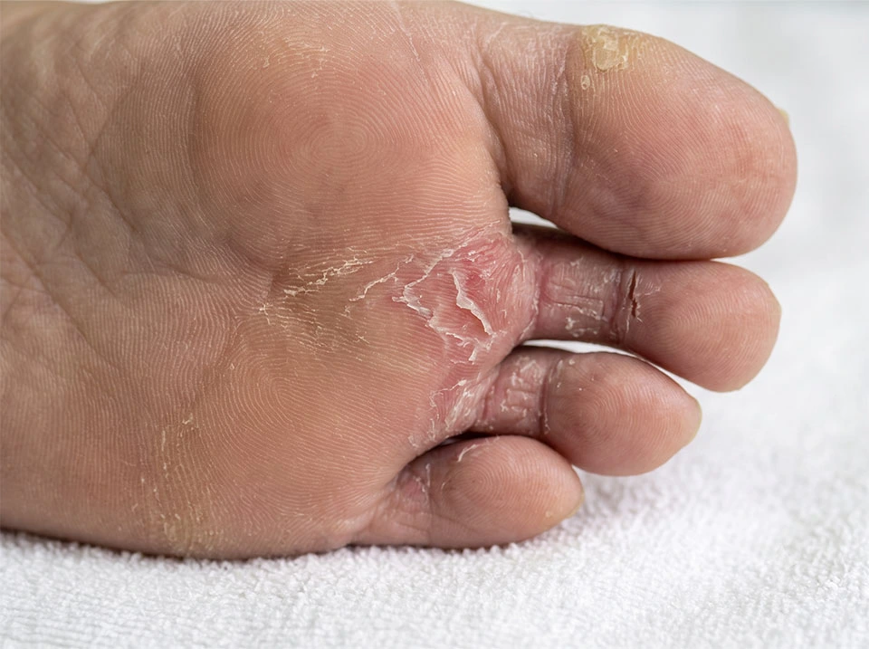 Tratamiento dermatológico y podológico de pie de atleta y micosis