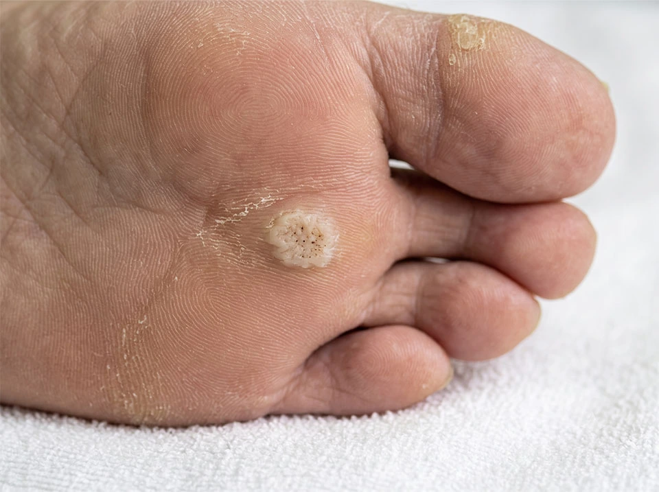 Tratamiento especializado para eliminar verruga plantar u ojos de pescado